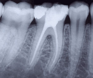 Leczenie endodontyczne